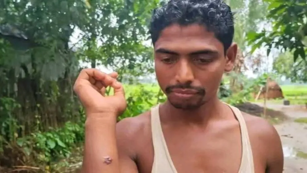 গ্রামের ১১ জনে অ্যানথ্রাক্সের উপসর্গ শনাক্ত