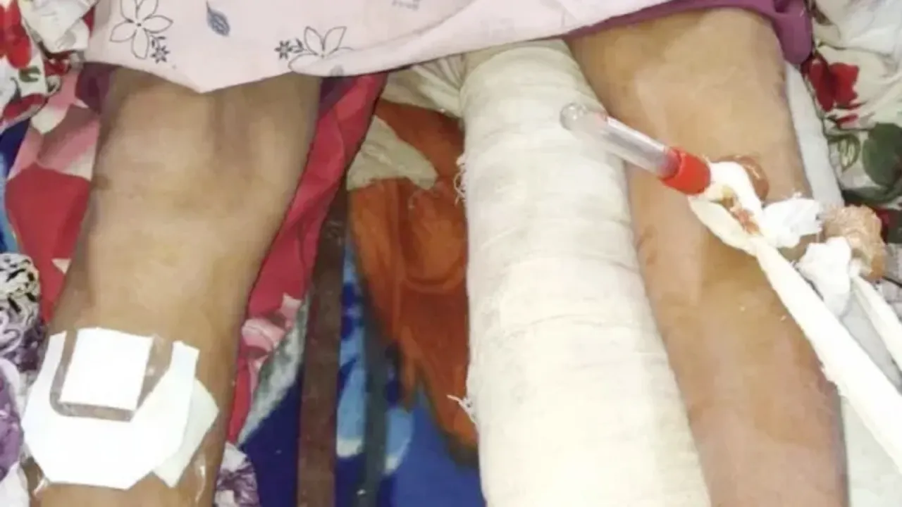 রোগীর বাম পায়ের হাড় ভাঙা। কিন্তু অপারেশন করা হলো ডান পায়ে। 